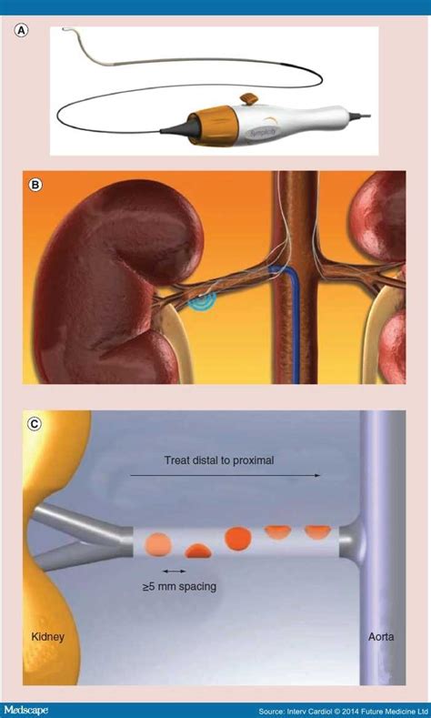 Renal Sympathetic Denervation: Indications, Contemporary Devices