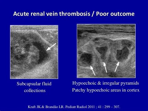 Doppler ultrasound of the kidneys | Ultrasound, Ultrasound sonography ...