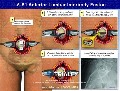 L5-S1 Anterior Lumbar Interbody Fusion - Trial Exhibits Inc.