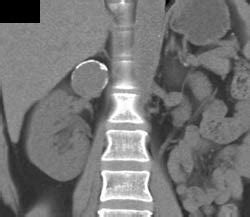 Renal Artery Aneurysm - Kidney Case Studies - CTisus CT Scanning