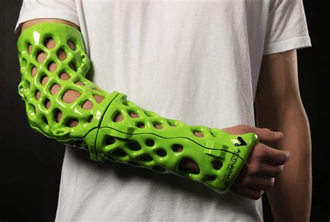 Startup reinventing casts for broken limbs looks to raise another ...