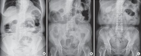 Figure 1 from A Case of Successful Colonoscopic Treatment of Colonic Obstruction Caused by ...