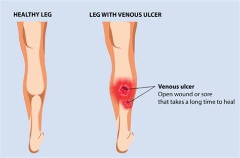 Leg ulcer treatment | varicose veins treatment in Panvel | Surekha ...