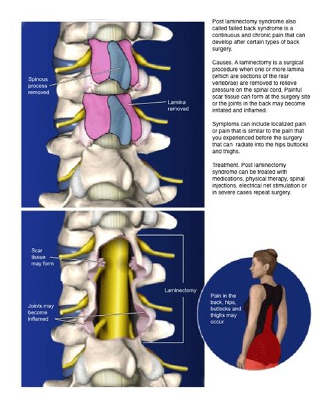 What is the ICD-10 code for post lumbar laminectomy syndrome? - Health Blog