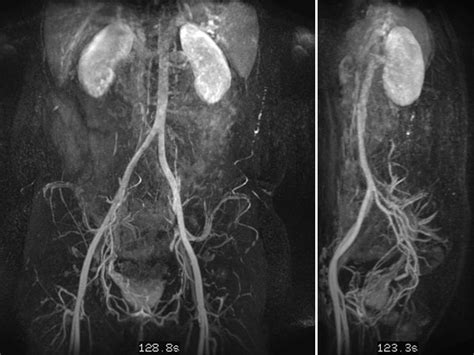 Compva: Differential diagnosis of intramuscular venous malformation