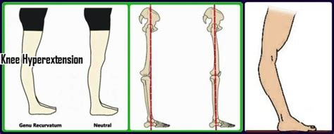 Genu Recurvatum - Definition, Treatment, Causes, Types, Symptoms