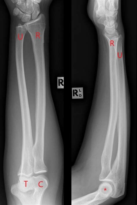 Radius And Ulna X Ray