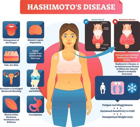 Hashimoto’s Syndrome – Symptoms, Causes, & Treatments (2022)