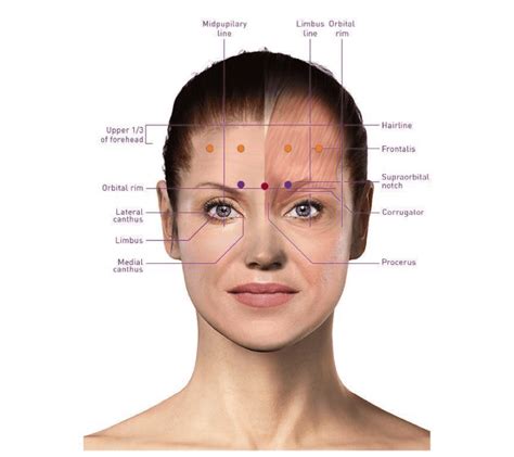 Botox Diagram For Injections