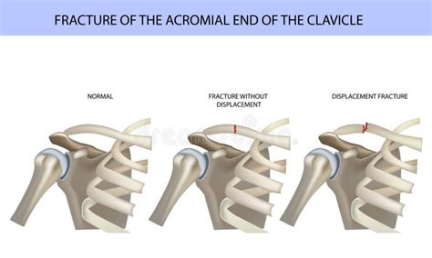 Fracture of the Acromial End of the Clavicle, Medical Vector ...