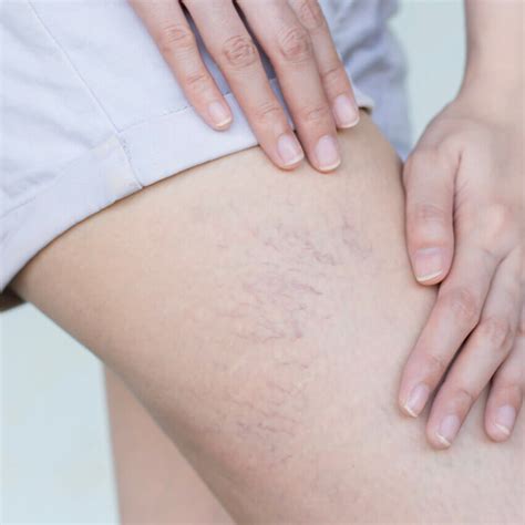 Thread Veins and Spider Veins Treatment London | Adonia Medical Clinic