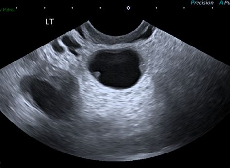 Tubo Ovarian Abscess On Ultrasound