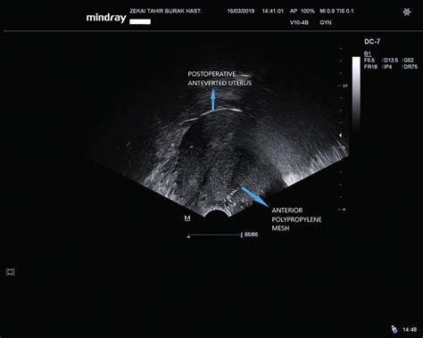 Postoperative transvaginal ultrasonographic view of anteverted uterus ...