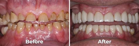 Full Mouth Reconstruction – Premier Dental