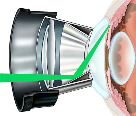 Gallery - Glaucoma Associates of Texas