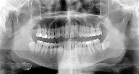 Jaw Cancer Xray - CancerWalls