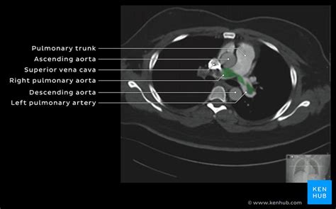 Pulmonary embolism: Clinical anatomy | Kenhub