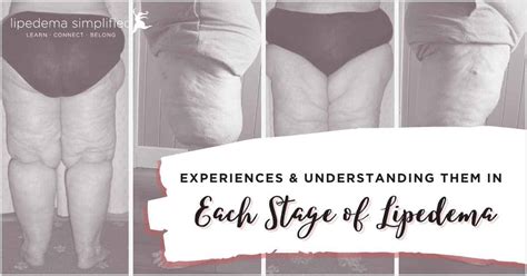 Stages of Lipedema: Understanding the Experiences of Patients