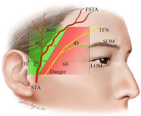 Illustration of the surgical safe and danger zones during a biopsy of ...