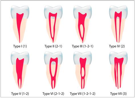 Diagnostics | Free Full-Text | Evaluation of Root Canal Configuration ...