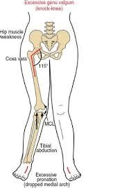 Coxa Vara : Cause, Pathophysiology, Sign/symptoms, Treatments