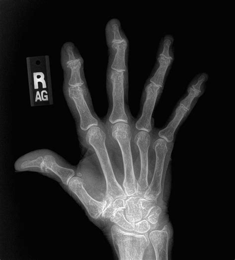 xrays of hand arthritis