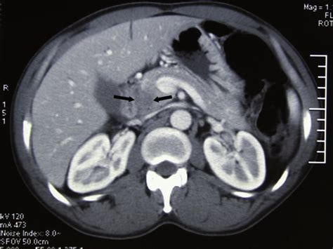 CT scan image demonstrating a 3x2 cm hypodense lesion in the head of... | Download Scientific ...