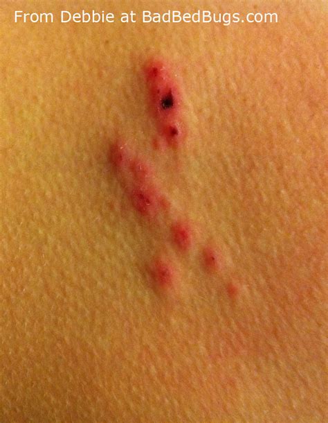 Can Old Bed Bug Bites Flare Up Again - PestPhobia