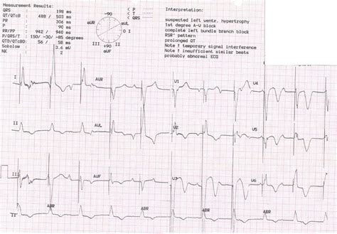 Dr. Smith's ECG Blog: Giant Inverted T waves in an Elderly Patient