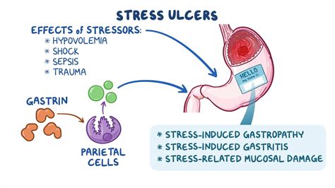 Stress ulcers: Clinical sciences - Osmosis Video Library