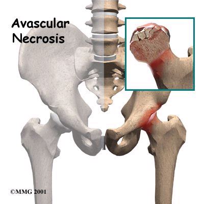 Avascular Necrosis (AVN) Specialist | 🩺Singapore Sports & Orthopaedic ...