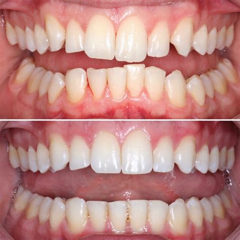 Invisalign Before And After Crowding