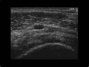 Musculoskeletal Joints and Tendons | 6.1 Shoulder : Case 6.1.19 Bursa: Miscellaneous bursa ...