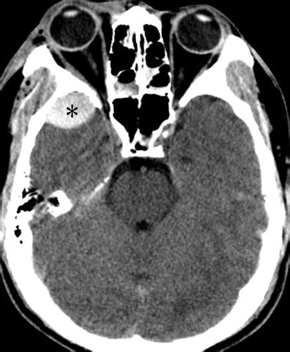 Benign Anterior Temporal Epidural Hematoma: Indolent Lesion with a Characteristic CT Imaging ...