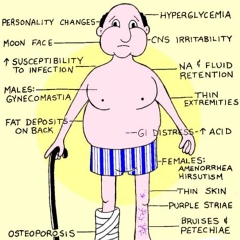 A case of Cushing syndrome due to steroid administration, showing ...