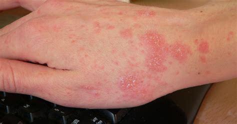 Asheville nursing home residents, staff treated for scabies