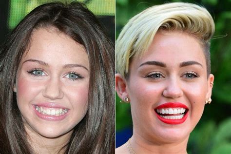 Antes e depois dos dentes das celebridades - We Fashion Trends ...