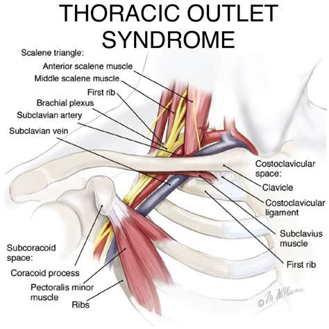 Doctor for Veins and Arteries: Understanding Thoracic Outlet Syndrome Causes in California