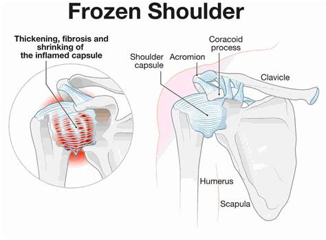 Symptoms, Stages & Treatment for Frozen Shoulder | Learn More