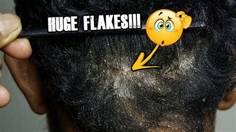 Dandruff Removal Big Flakes !! Scratching Dandruff Off Scalp Black Hair - YouTube