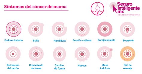 Cancer De Mama Conoce Cuales Son Los Sintomas Y Causas Del Cancer De Images | Sexiz Pix