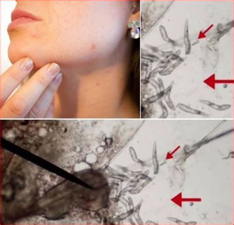 Pin by Ungex on Skin Care by Paula Leslie | Demodex, Demodex treatment, Skin problems