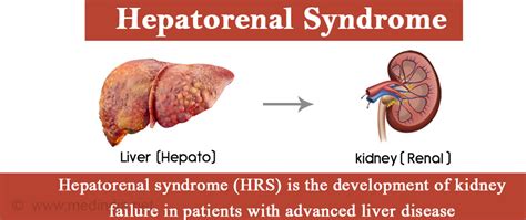 Hepatorenal Syndrome - Causes, Clinical features, Diagnosis & Treatment