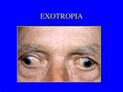 PPT - EXOTROPIA PowerPoint Presentation - ID:414817