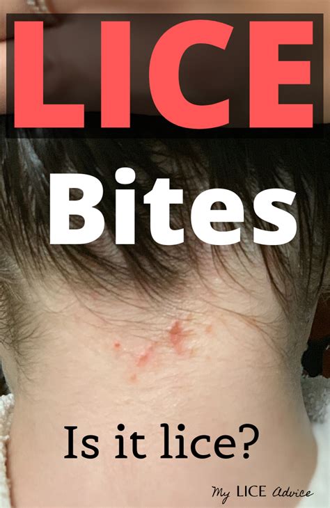 A Closer Look at Lice Bites and Rashes with Pictures - My Lice Advice