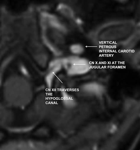 Jugular Foramen Mri