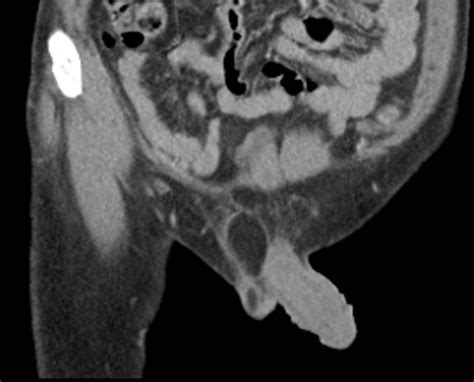 Liposarcoma of the Testis and Spermatic Cord