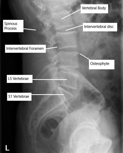 Case Study: Lumbar Stenosis Management in 63 yr. Old Female