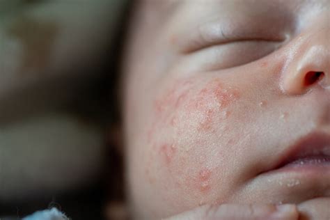 Common Newborn Rashes - Pediatrics West