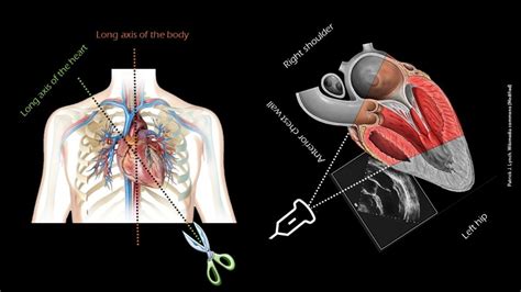 Introduction to Focused Cardiac Ultrasound: The Parasternal Long Axis View - Renal Fellow Network